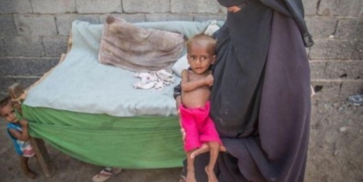 أزمة_اليمن: “موت 85 ألف #طفل” بسبب سوء التغذية الحاد