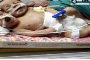 في حالة تعد الاولى من نوعها .. ولادة طفل يمني براسين في ##صنـعاء