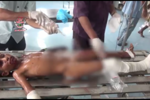 إستشهاد طفل وإصابة شقيقه بجروح بإنفجار عبوة ناسفة من مخلفات الحوثي في الحيمة بالتحيتا 