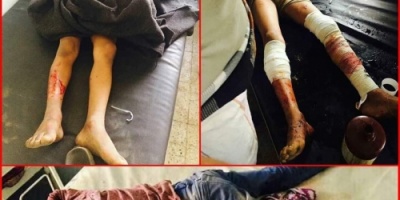الضالع : إصابه ٤ اطفال بجروح  إثر انفجار مقذوف حوثي 
