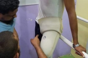 التحالف العربي يركب طرف صناعي لمواطن بقيمة 13 الف دولار 