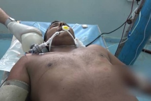 إصابة مواطن بإنفجار لغم من مخلفات الحوثي في الخوخة جنوب الحديدة