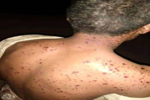 مليشيات المرتزقة في شقرة تستخدم سلاح محرم دوليا