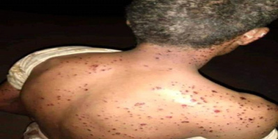 مليشيات المرتزقة في شقرة تستخدم سلاح محرم دوليا
