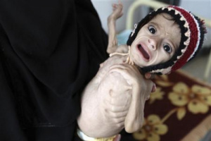 سوء التغذية في اليمن.. سرطان حوثي ينهش بطونًا خاوية  