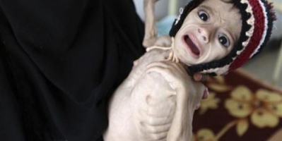 سوء التغذية في اليمن.. سرطان حوثي ينهش بطونًا خاوية  