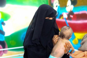 ارتفاع كبير في معدلات سوء تغذية الأطفال باليمن