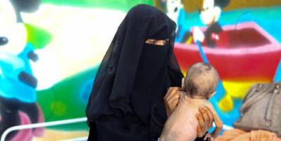 ارتفاع كبير في معدلات سوء تغذية الأطفال باليمن