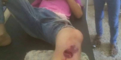 إصابة أربعة مدنيين ببقايا مقذوفات متفجرة في حادثين منفصلين شمال وشمال غرب الضالع