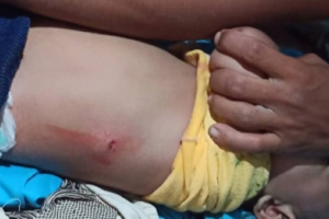 إصابة طفل برصاص مليشيات الحوثي في حيس جنوب الحديدة 