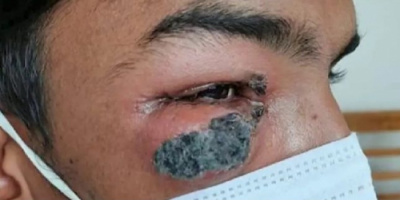 احذر 5 أشياء في منزلك تنقل لك الفطر الأسود
