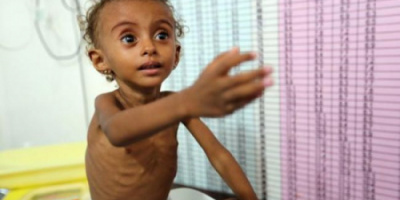الصحة العالمية: سوء التغذية يبلغ مستويات قياسية في اليمن هذا العام