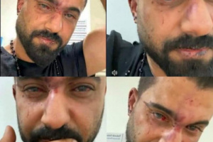 الفنان العدني عدنان الخضر يتعرض لاعتداء دموي من قبل الأمن التركي