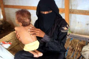 الغارديان : 5 ملايين على شفا المجاعة و 16 مليون آخرين يسيرون بنفس الاتجاه