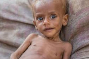 اليونيسف: سوء التغذية يهدد أكثر من مليوني طفل يمني