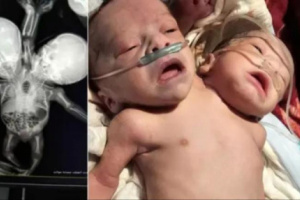 حدث طبي نادر يثير الجدل في ذمار