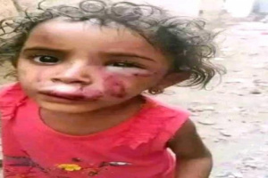 أم تعذب طفلتها بوحشية في تعز بعد اتهامها بفقدان الذهب