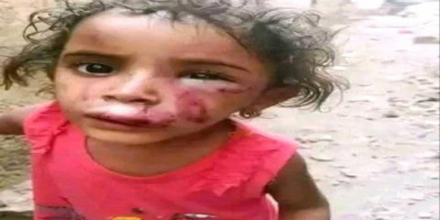 أم تعذب طفلتها بوحشية في تعز بعد اتهامها بفقدان الذهب