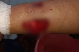 إصابة مواطنة بجروح خطيرة جراء قصف مدفعي لمليشيا الحوثي على مديرية حيس