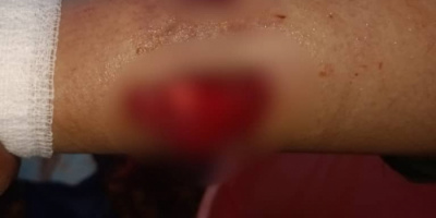 إصابة مواطنة بجروح خطيرة جراء قصف مدفعي لمليشيا الحوثي على مديرية حيس