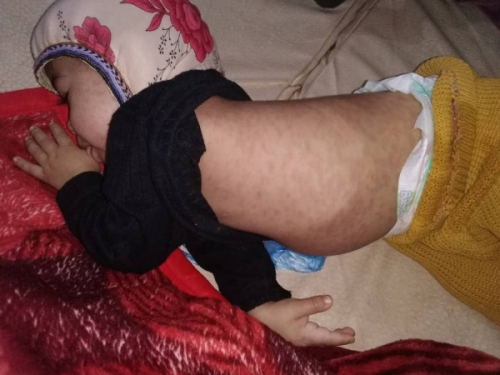 وفاة 4 أطفال بالحصبة خلال النصف الأول من الشهر الجاري