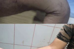 إنجاز طبي جديد في عدن.. الدكتور عادل الحاج ينجح في إجراء عملية معقدة لإصلاح ذراع مريض بمستشفى عبود العسكري 
