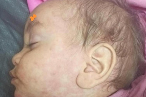 انتشار مخيف لمرض الحصبة في مسيمير لحج والأهالي يناشدون السلطات الصحية
