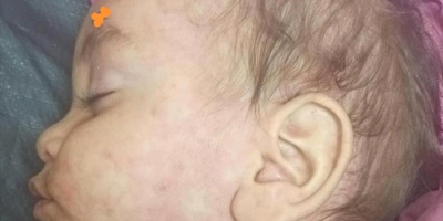 انتشار مخيف لمرض الحصبة في مسيمير لحج والأهالي يناشدون السلطات الصحية