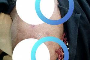 إصابة إمرأة برصاصة قناص حوثي شمال غربي حجر – الضالع