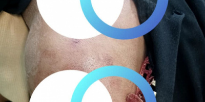 إصابة إمرأة برصاصة قناص حوثي شمال غربي حجر – الضالع