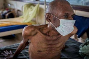 مرض معدي يسبب وفاة أكثر من مليون شخص حول العالم