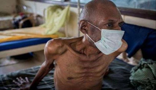 مرض معدي يسبب وفاة أكثر من مليون شخص حول العالم مرض معدي يسبب وفاة أكثر من مليون شخص حول العالم